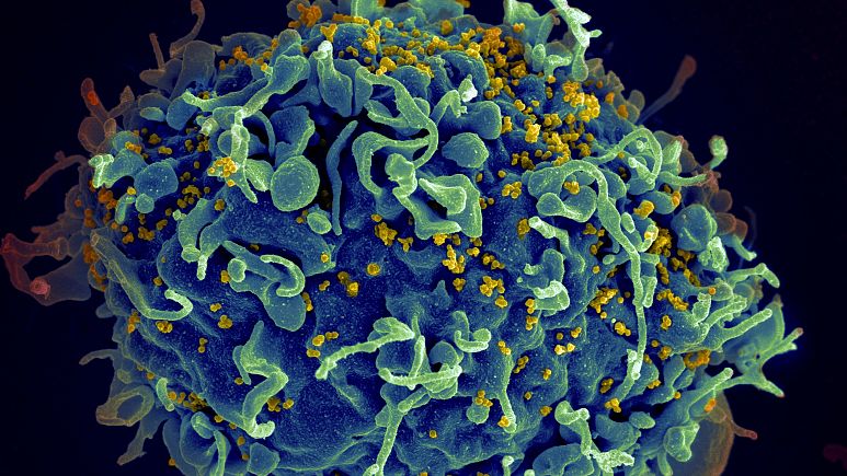 HIV nedir? Türkiye ve Avrupa ülkelerinde kaç kişi AIDS nedeniyle hayatını kaybediyor?